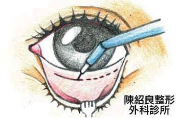 眼袋內開合併脂肪移位手術 眼袋內開合併脂肪移位手術