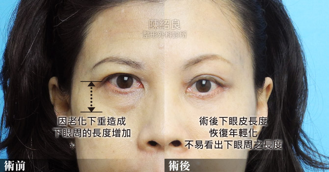 除眼袋推薦
