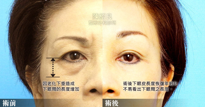 除眼袋費用