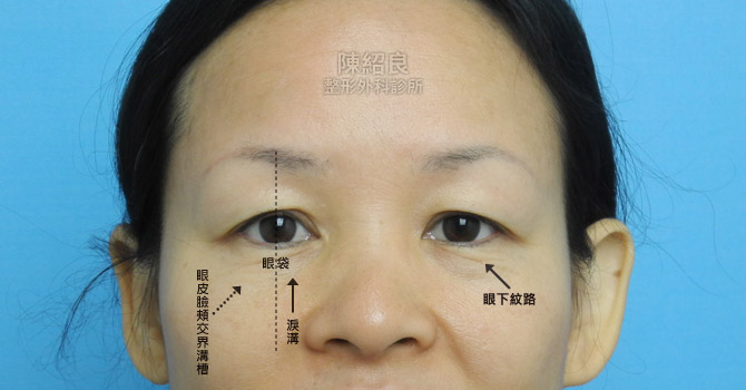 眼袋外開