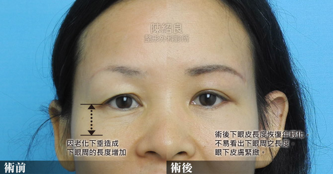 眼袋外開手術