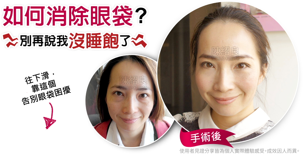 如何消除眼袋 如何消除眼袋