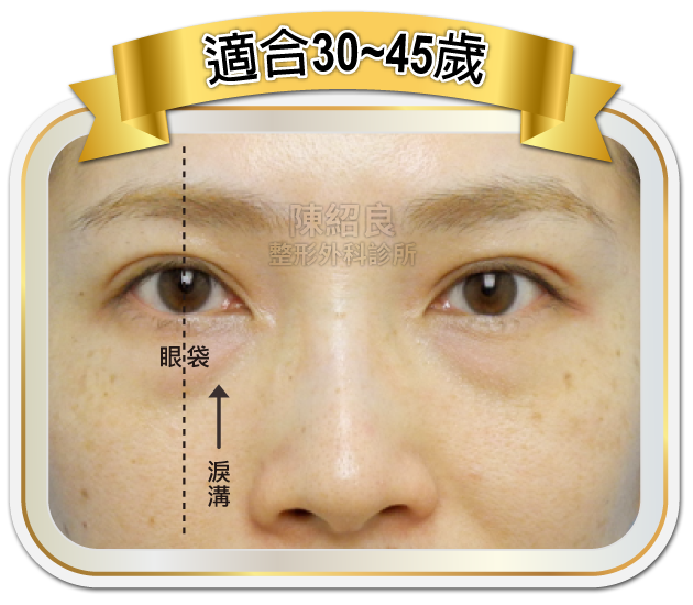 眼袋內開合併脂肪移位手術 眼袋內開合併脂肪移位手術