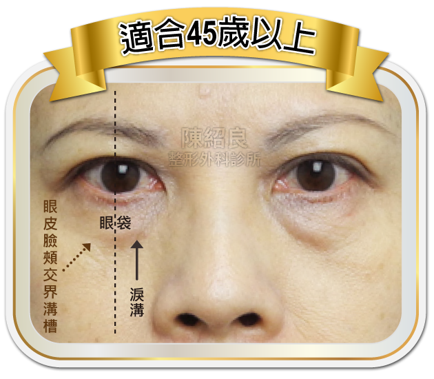 眼袋內開合併脂肪移位手術 眼袋內開合併脂肪移位手術