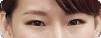 內雙眼皮 內雙眼皮